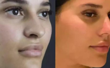 Latest Trends in Rhinoplasty in Dubai