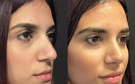 Advanced Techniques in Rhinoplasty Surgery in Dubai