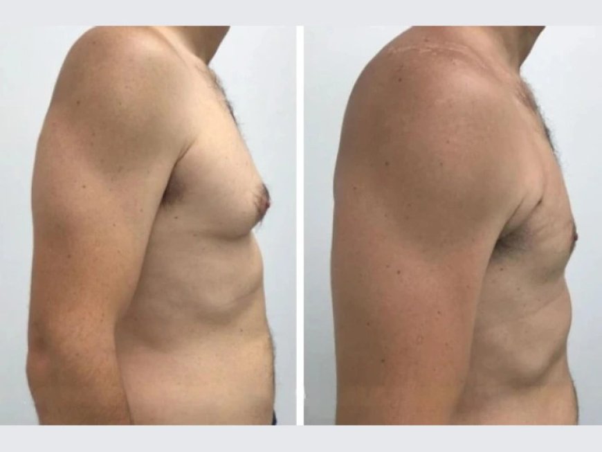 Why You Should Trust the Best Doctors in Dubai for Your Gynecomastia Treatment