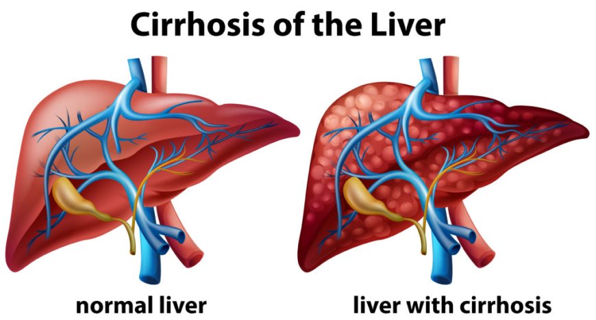 Liver Cirrhosis – Causes, Symptoms & Advanced Treatment Options